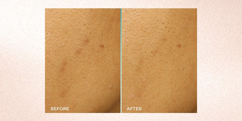 In Article How To Get Clear Skin Bright Reveal Peel
